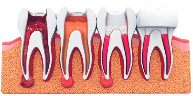 Show root canal procedure
