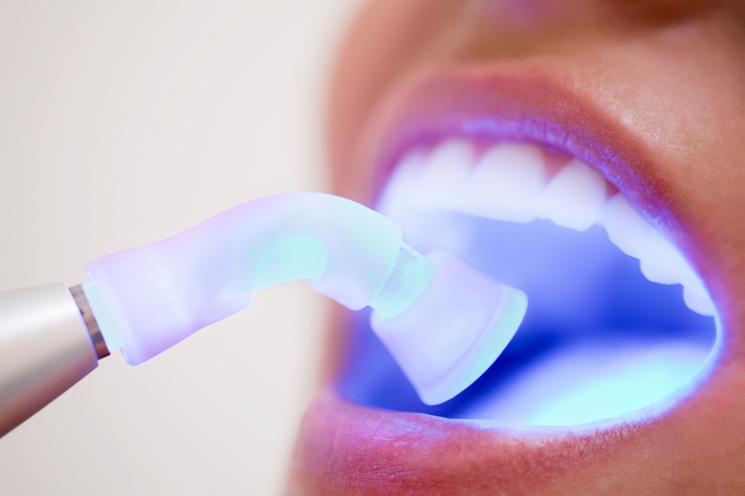 How Long Do Dental Fillings Last?