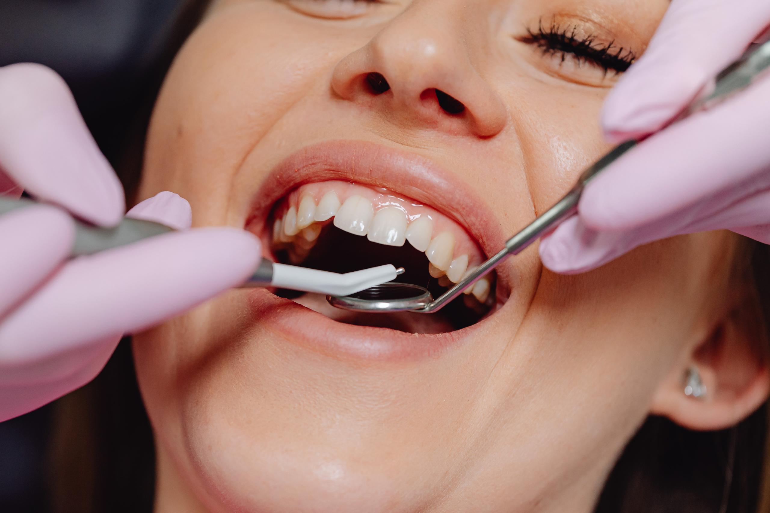 Veneers vs. Bonding: Which Option Is Best for You?