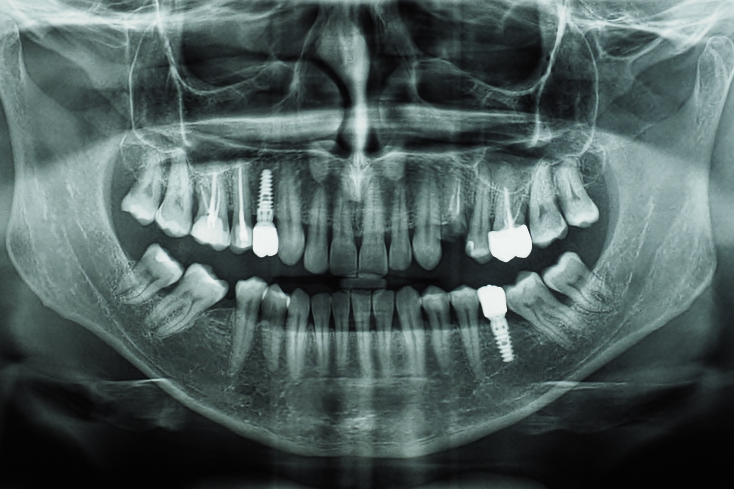 Everything You Need to Know About Dental Implants in 2025