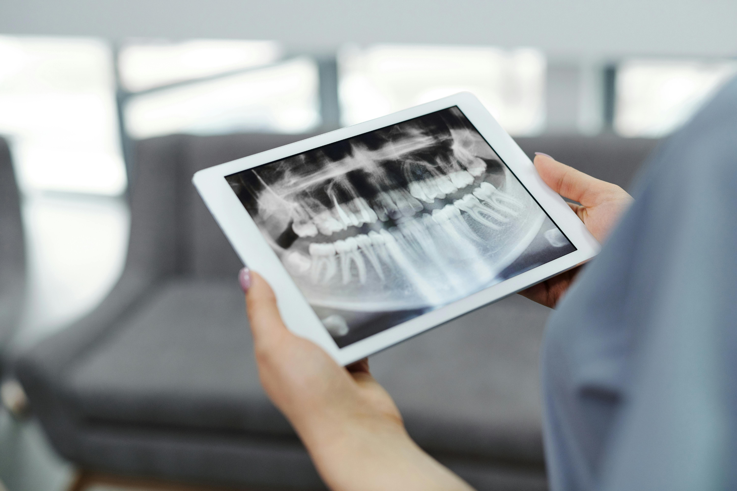 Top Benefits of Wisdom Teeth Removal in 2025: What You Need to Know