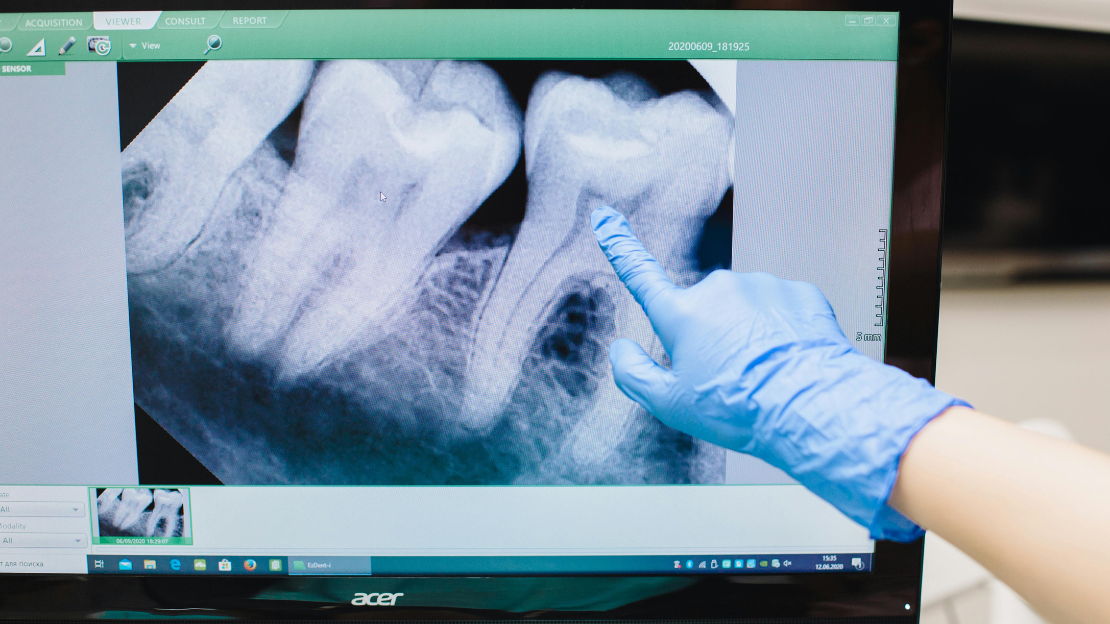 Wisdom Teeth Removal: Your Complete Guide to Understanding and Managing the Process