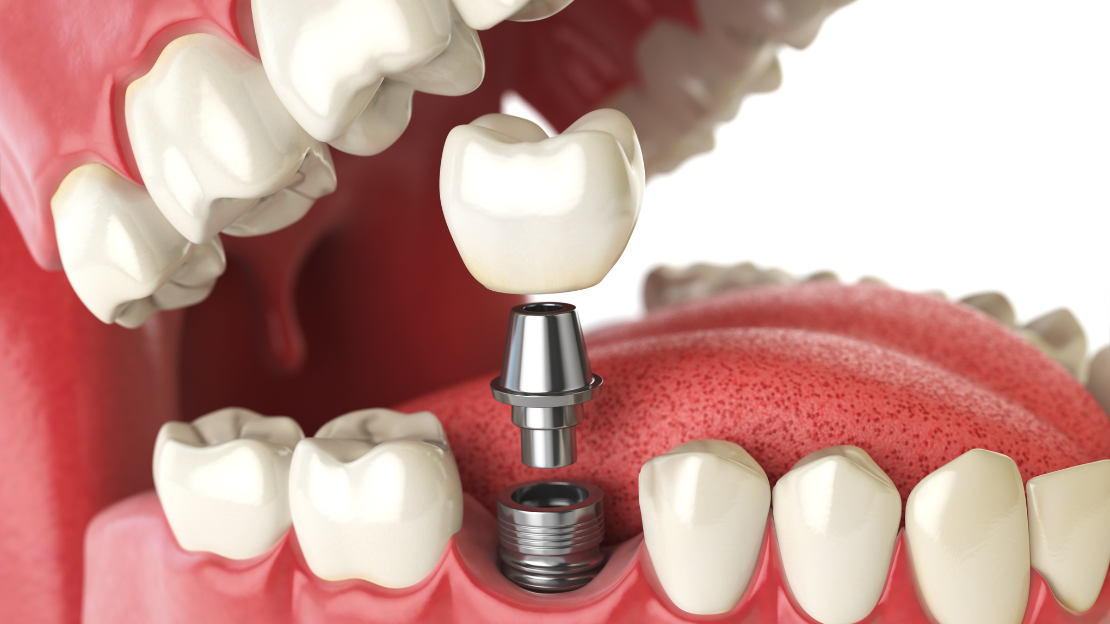 Are Dental Implants in Woodcliff Lake, NJ Worth the Cost? What You’re Really Paying For
